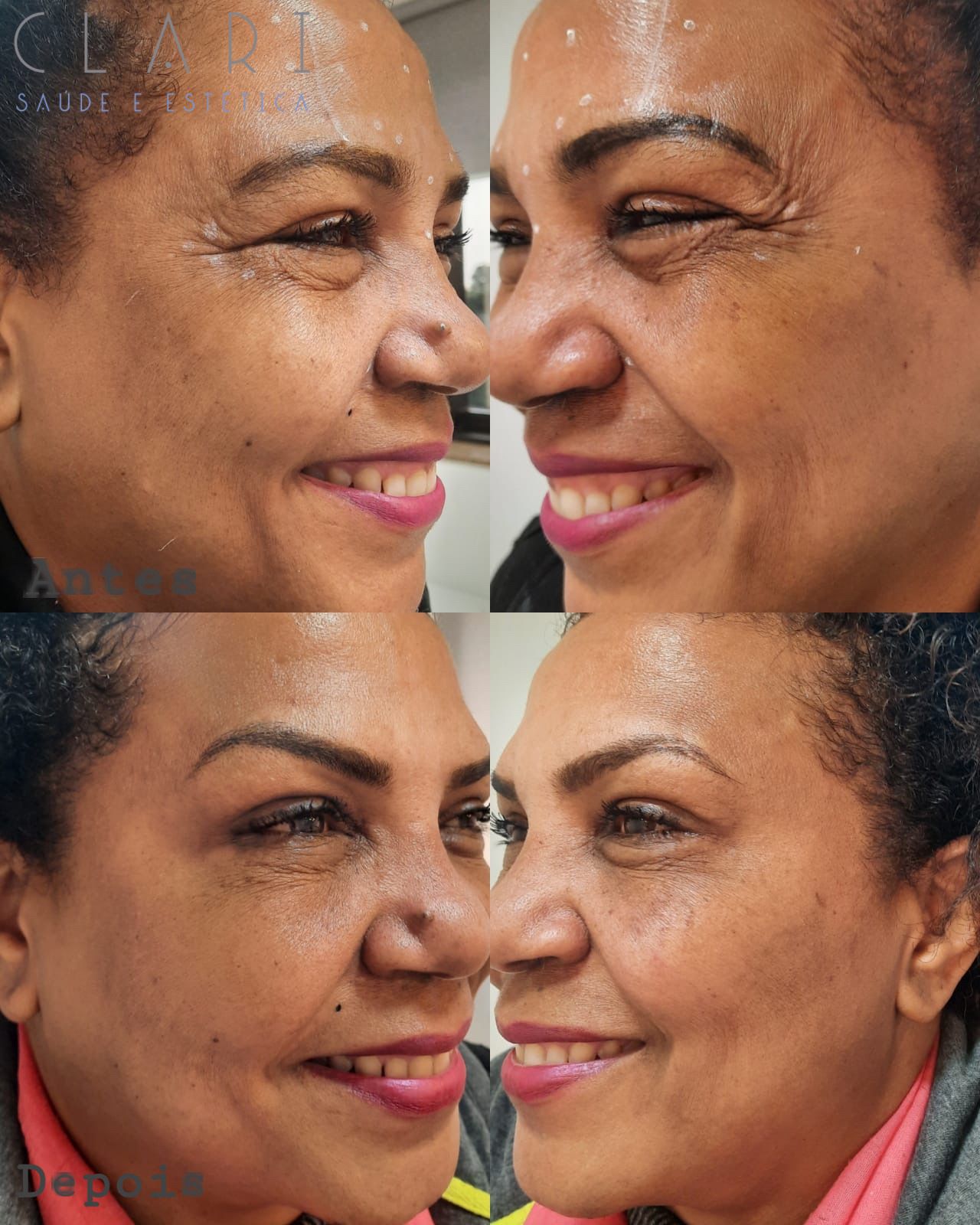 clinica-clari-botuclari-antes-e-depois-1
