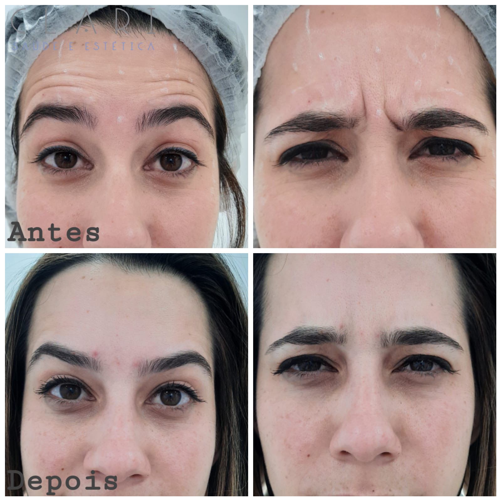 clinica-clari-botuclari-antes-e-depois-2