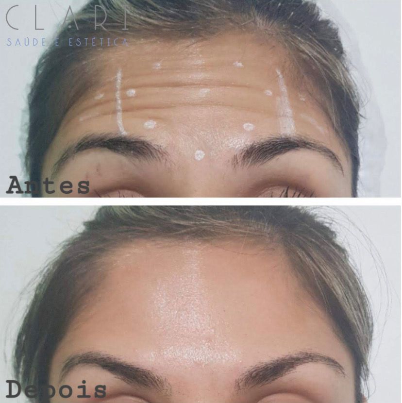 clinica-clari-botuclari-antes-e-depois-3