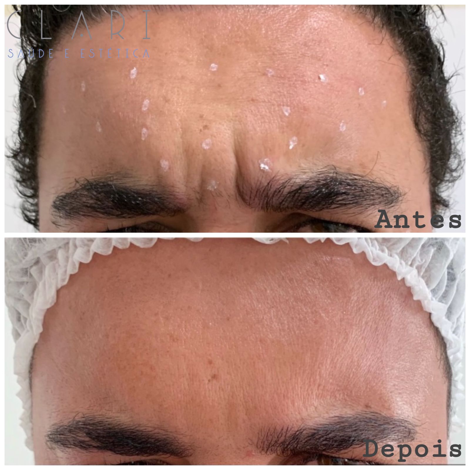clinica-clari-botuclari-antes-e-depois-4