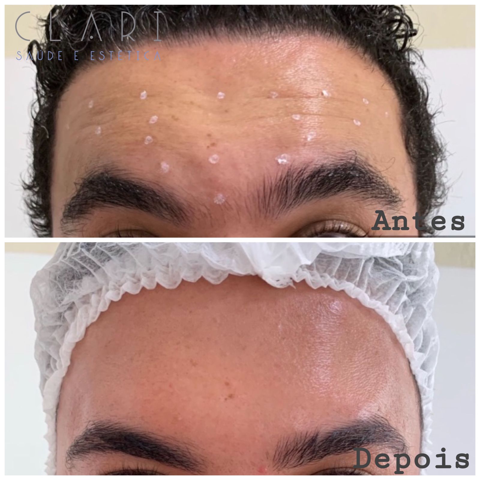clinica-clari-botuclari-antes-e-depois-5