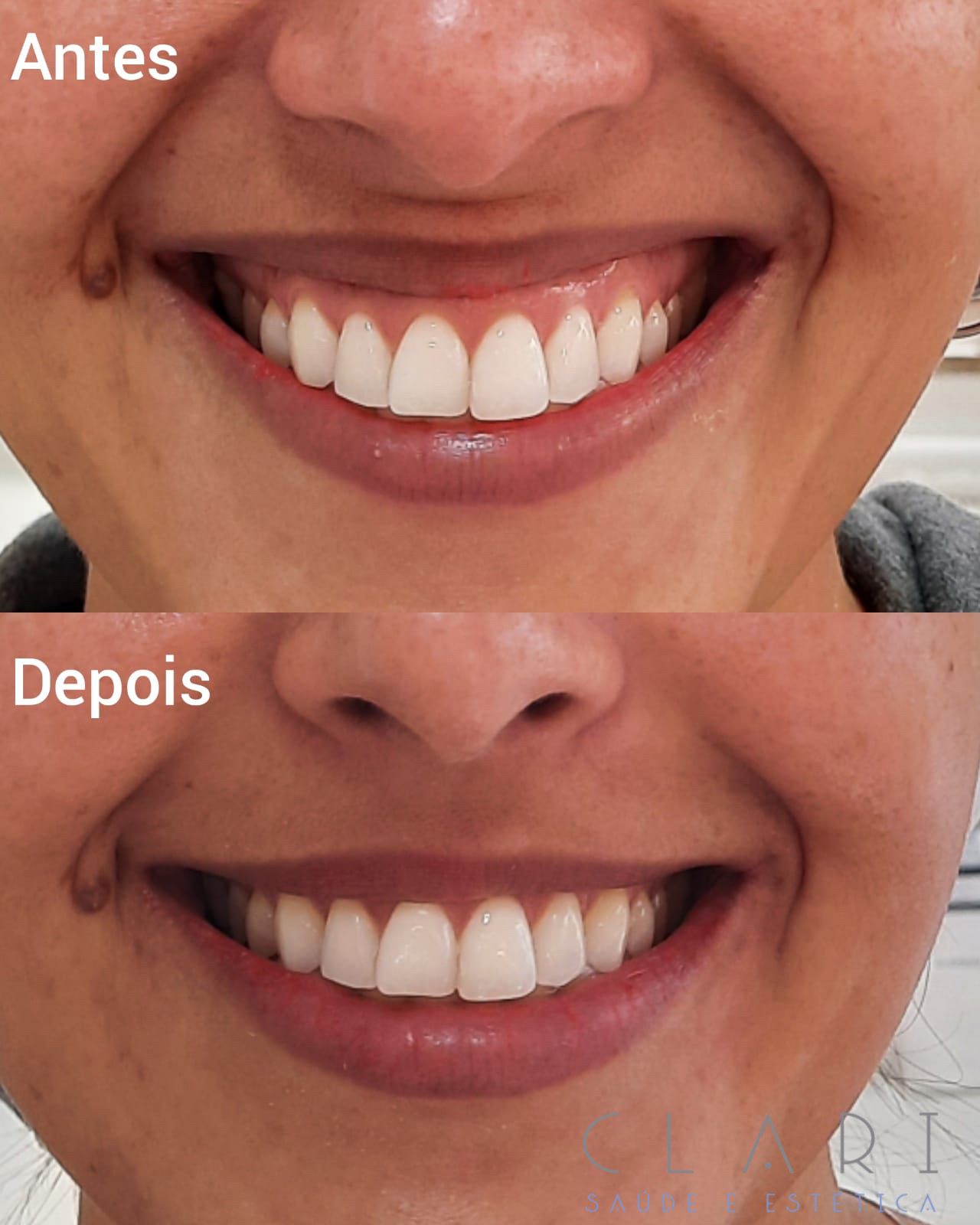 clinica-clari-botuclari-antes-e-depois-6